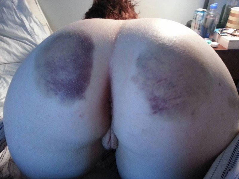 Bruised From Her Spanking And Ready For Sex - Spanking Blog